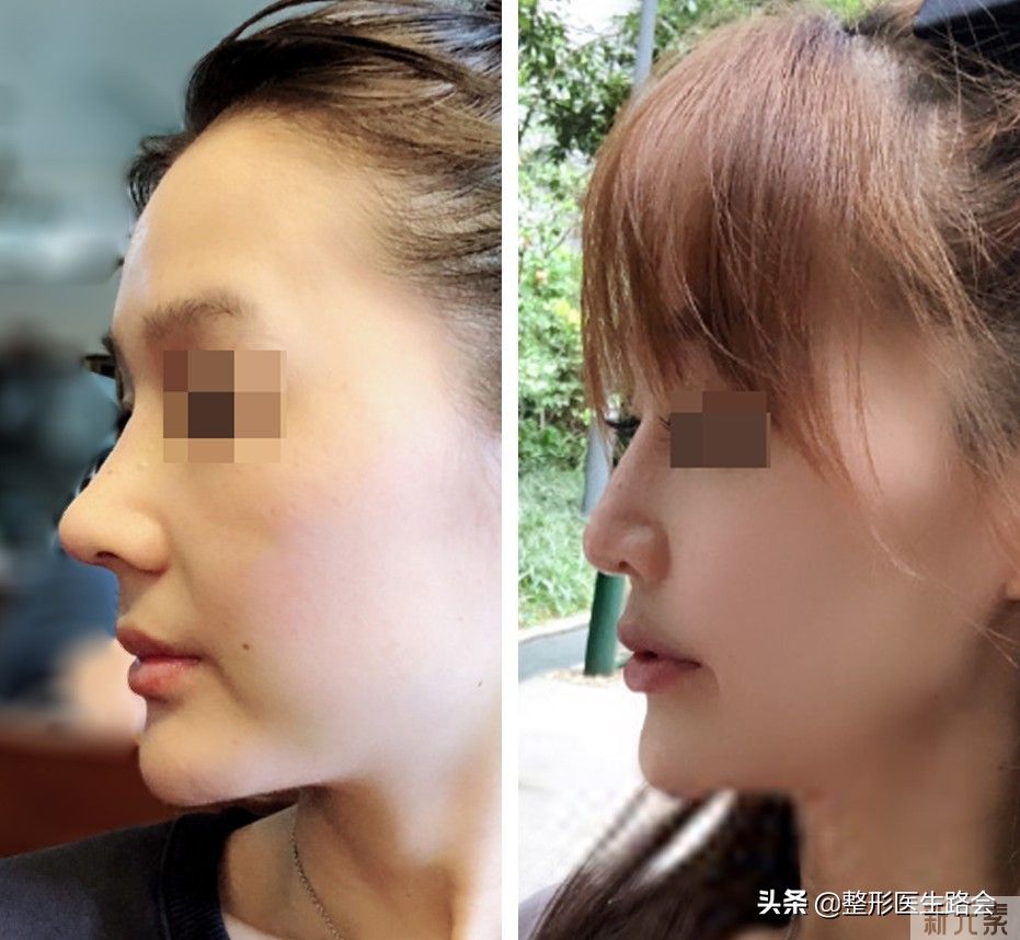 医生的审美、技术都没问题，为啥你隆鼻后:歪?矮?生硬?朝天? 图片-4