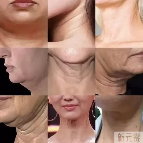 脖子松弛、下垂怎么办?讲讲大家都忽略的颈部年轻化  图片-5