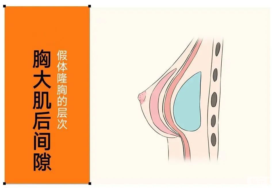 假体隆胸那些事，你真的了解吗? 图片-7