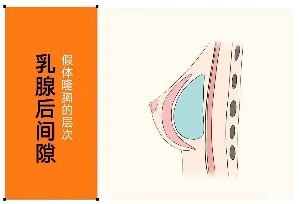 假体隆胸那些事，你真的了解吗? 图片-8