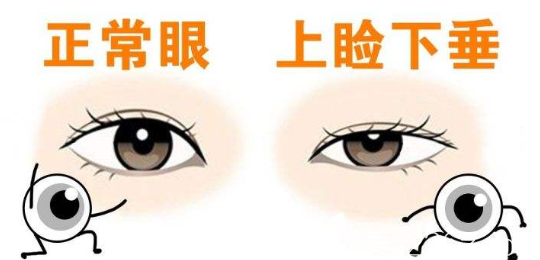 抬头纹还有天生的?那可能是眼睛惹的祸! 图片-4