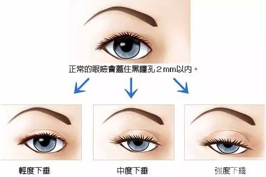 抬头纹还有天生的?那可能是眼睛惹的祸! 图片-5