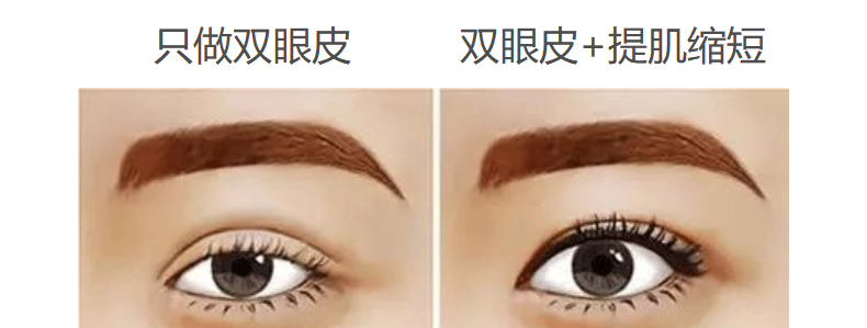抬头纹还有天生的?那可能是眼睛惹的祸! 图片-6