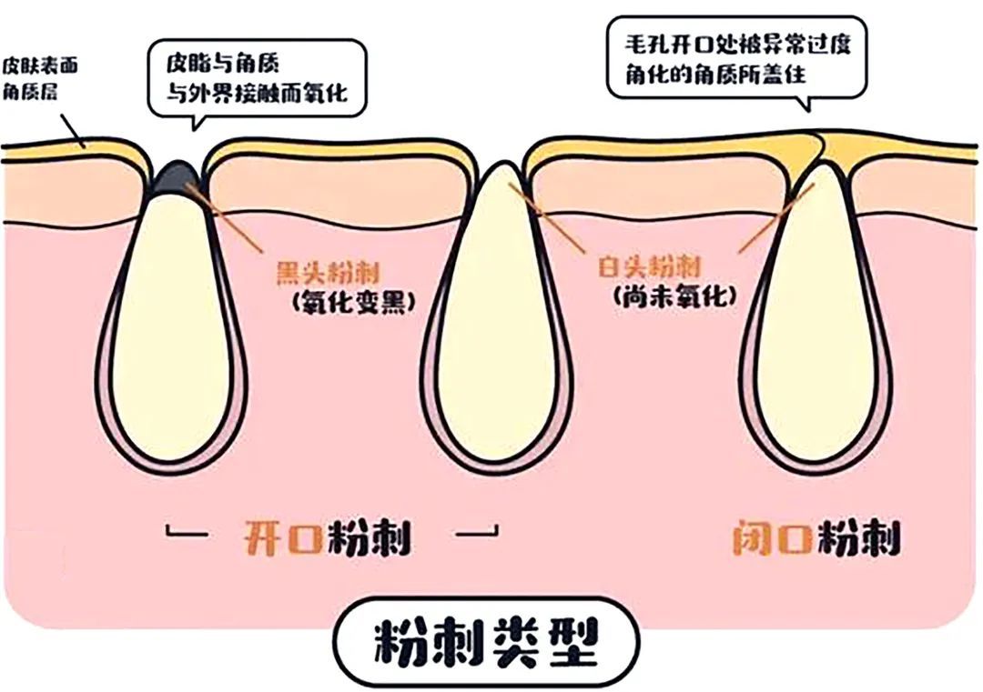 抿嘴时下巴凸起的白色小颗粒是什么? 图片-10