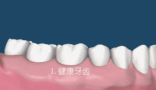 牙结石还会长在牙龈下面?要怎么清理呢? 图片-5