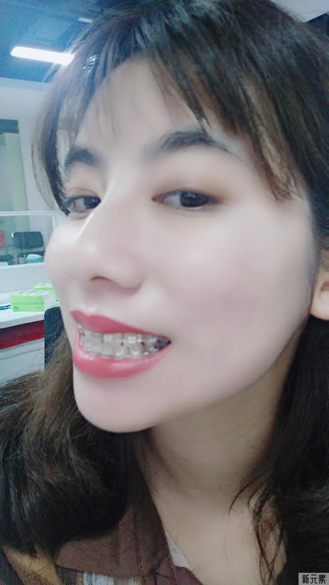 【登特口腔正畸案例】整整22个月，她做到了! 图片-12