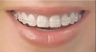 牙齿“矫正”的那些不为人知的事儿...... 图片-12