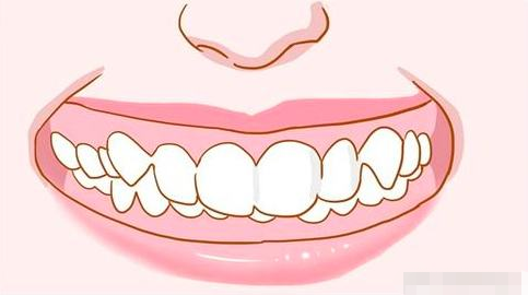 什么是隐适美牙齿矫正？还你自信笑容! 图片-5