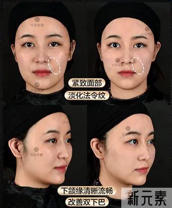当今医美顶流仪器怎么选?看完这篇省几万! 图片-8