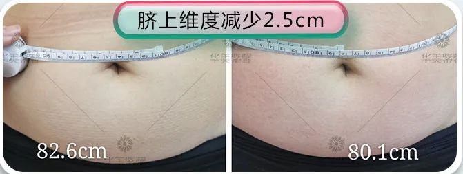当今医美顶流仪器怎么选?看完这篇省几万! 图片-10
