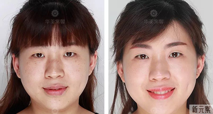 当今医美顶流仪器怎么选?看完这篇省几万! 图片-17