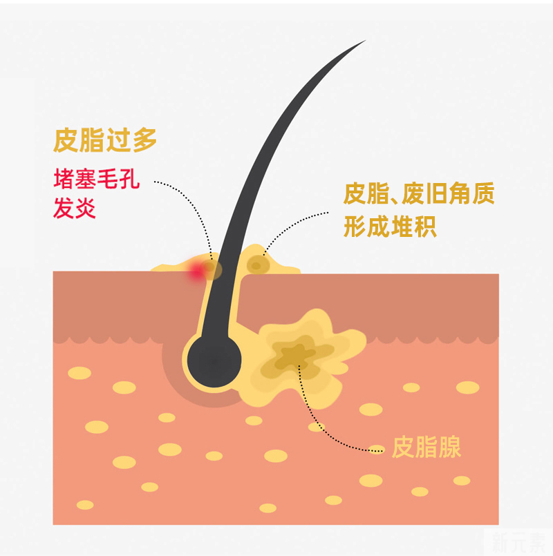 ​头皮爱出油一定会脱发吗?应该如何改善? 图片-3