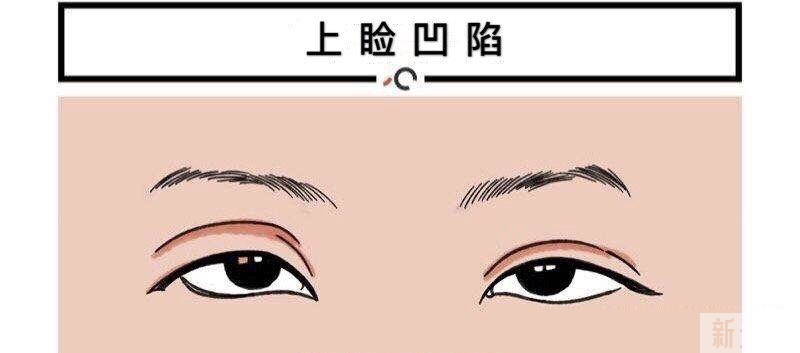 做双眼皮能改善上睑凹陷吗? 图片-5