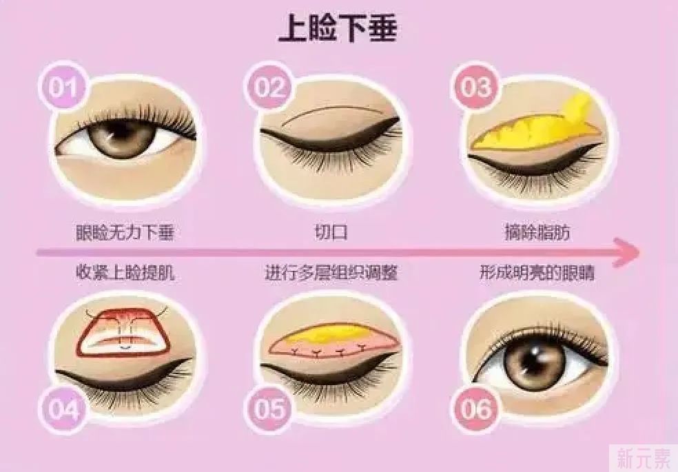 双眼皮术前必看，为什么医生建议你做提肌! 图片-5