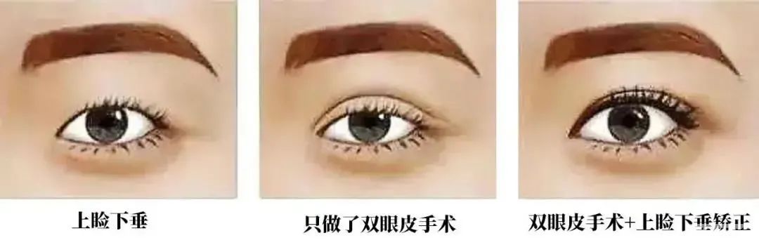 双眼皮术前必看，为什么医生建议你做提肌! 图片-4