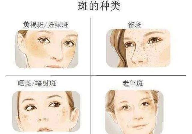 哪些人不适合做皮秒祛斑? 图片-4