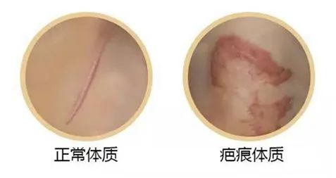 祛眼袋会留疤吗?疤痕体质能祛眼袋吗? 图片-4