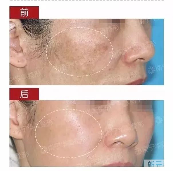 水光搭配这些医美项目一起做，效果真是绝绝子! 图片-10