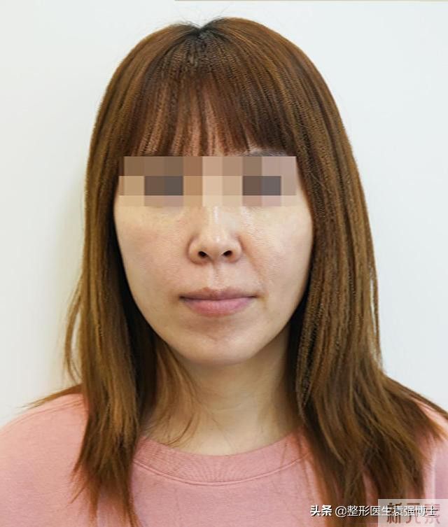 43岁大拉皮术后10天，下颌缘的改变“太惊艳”了，做了耳前切口 图片-3
