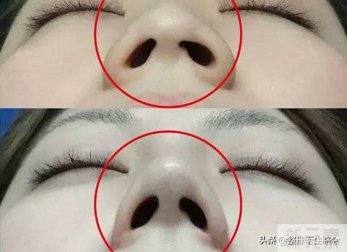 作为过来人，聊聊“鼻翼缩小”的3个感受!  图片-1