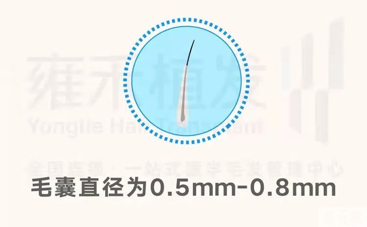 植发器械口径，真的越小越好吗? 图片-1