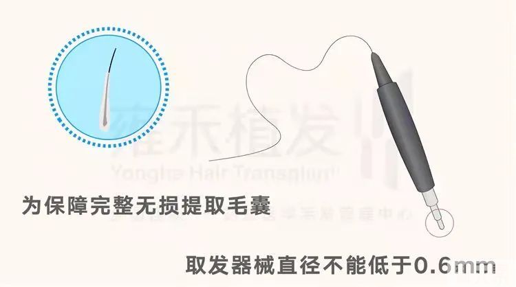 植发器械口径，真的越小越好吗? 图片-2