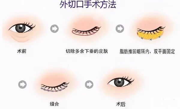 眼袋并不是老年人的专利，20+的小姑娘看起来像30+ 图片-9