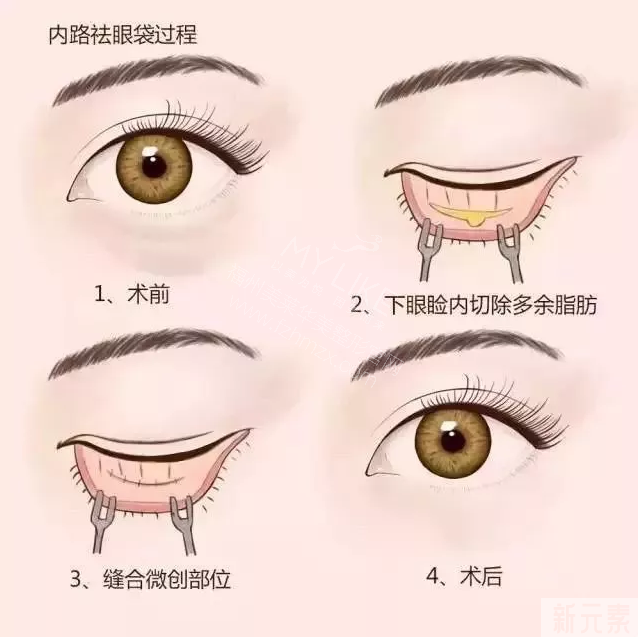 眼袋并不是老年人的专利，20+的小姑娘看起来像30+ 图片-10