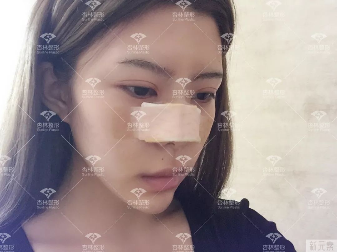 沈阳杏林整形案例分享|立体翘挺的鼻子，让我从路人到女神! 图片-8