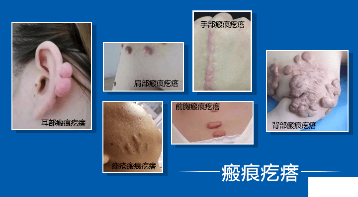 疤痕疙瘩拖久不治的后果，看完你还会想拖延你的疤吗? 图片-6