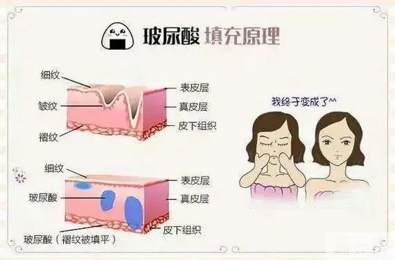 自体脂肪、玻尿酸?填充我到底该选哪一个 图片-6