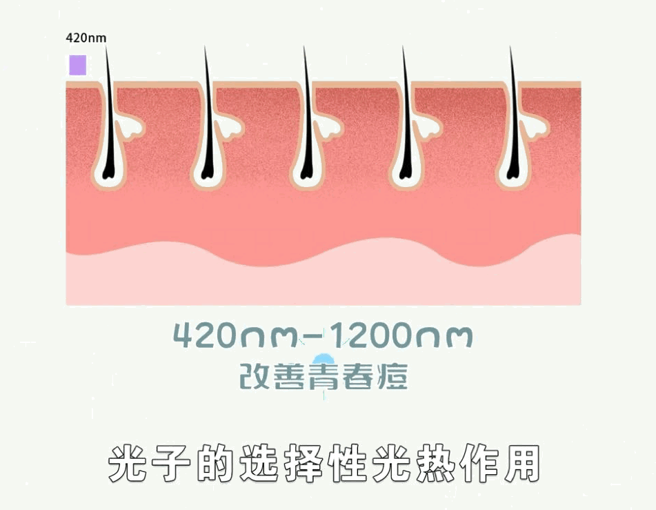 M22-AOPT超光子与普通光子嫩肤独特在哪里? 图片-3