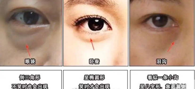 期待“卧蚕”却被做成“眼袋”?原因可能就这一点 图片-6