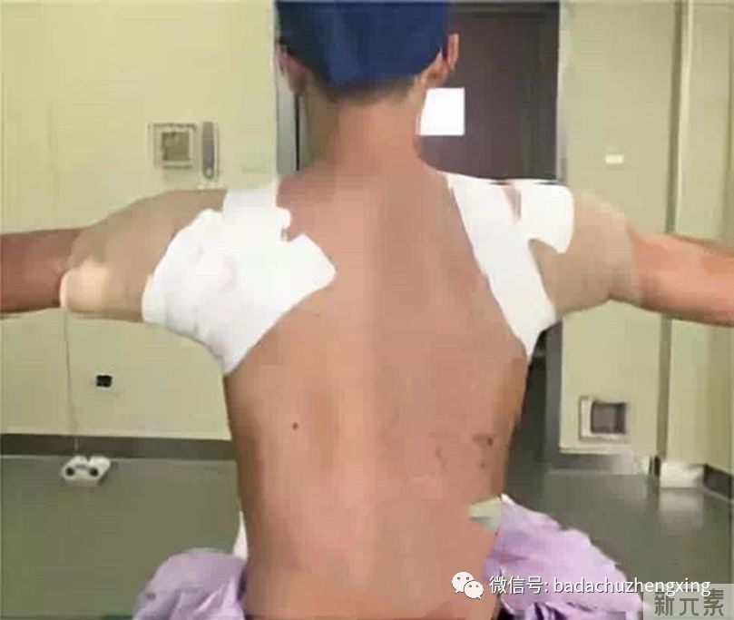 天气热了，尴尬的腋臭多汗症 图片-7