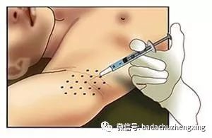 天气热了，尴尬的腋臭多汗症 图片-6