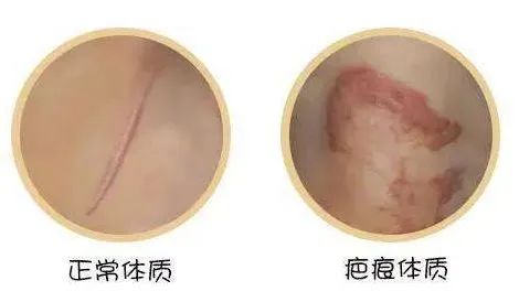 担心自己是疤痕体质，怎么判断? 图片-8