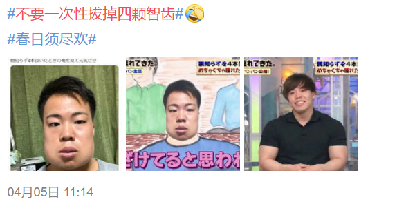 科普来了 | 为什么不建议一次性拔掉4颗智齿? 图片-2
