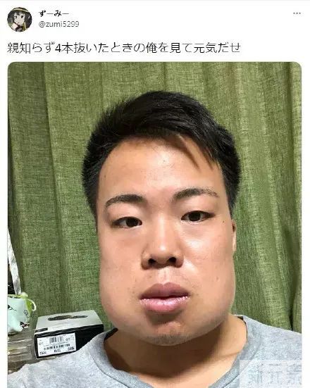 科普来了 | 为什么不建议一次性拔掉4颗智齿? 图片-4