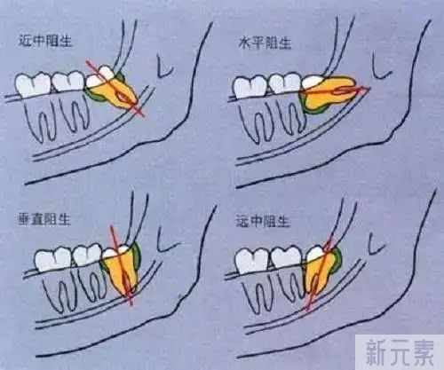 科普来了 | 为什么不建议一次性拔掉4颗智齿? 图片-18