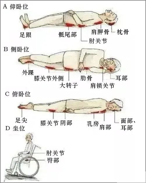 褥疮切除后的创面怎么修复? 图片-3