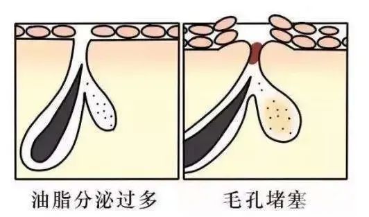 怎样改善毛孔粗大?这3中方法缩毛孔最有效 图片-7
