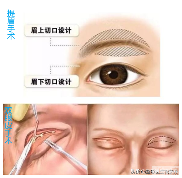 双眼皮和提眉手术能一起做吗 图片-1