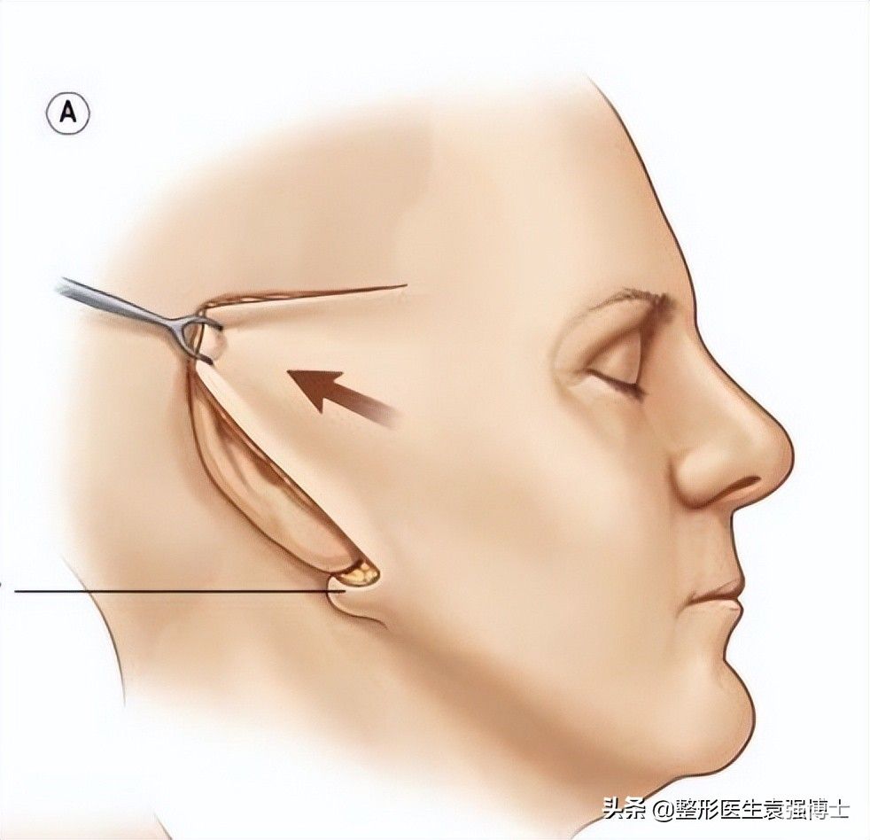 拉皮手术“后遗症”，医生总结这篇文章，一次性告诉你 图片-4