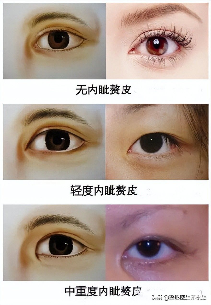 有内眦就必须开眼角吗?千万不要随便开眼角 图片-1