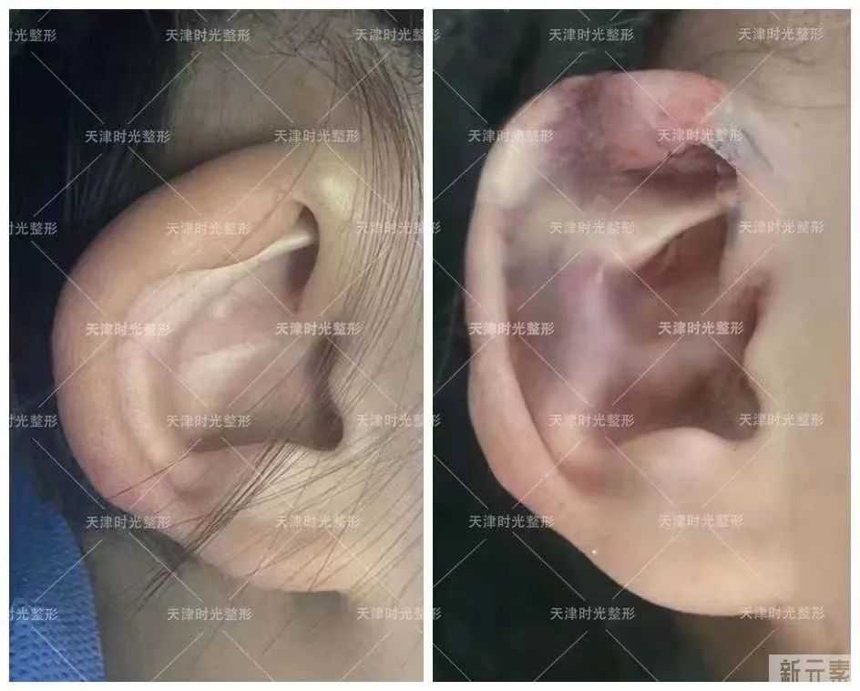 姚庆君教授:先天耳畸形高发需尽早干预，手术矫正“杯状耳”还孩子正常外观 图片-3