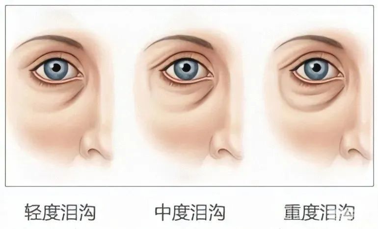 SOS!割了眼袋眼睛却凹陷了，这是咋个回事? 图片-5