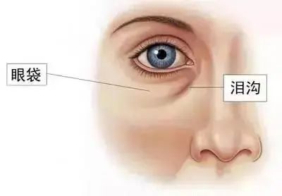 SOS!割了眼袋眼睛却凹陷了，这是咋个回事? 图片-4