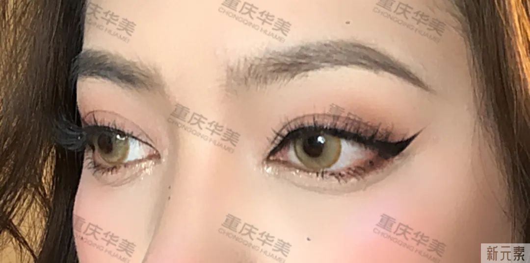 SOS!割了眼袋眼睛却凹陷了，这是咋个回事? 图片-8