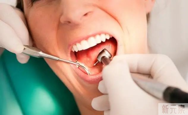 什么样的人适合去洗牙?这几类人必须安排上了 图片-5