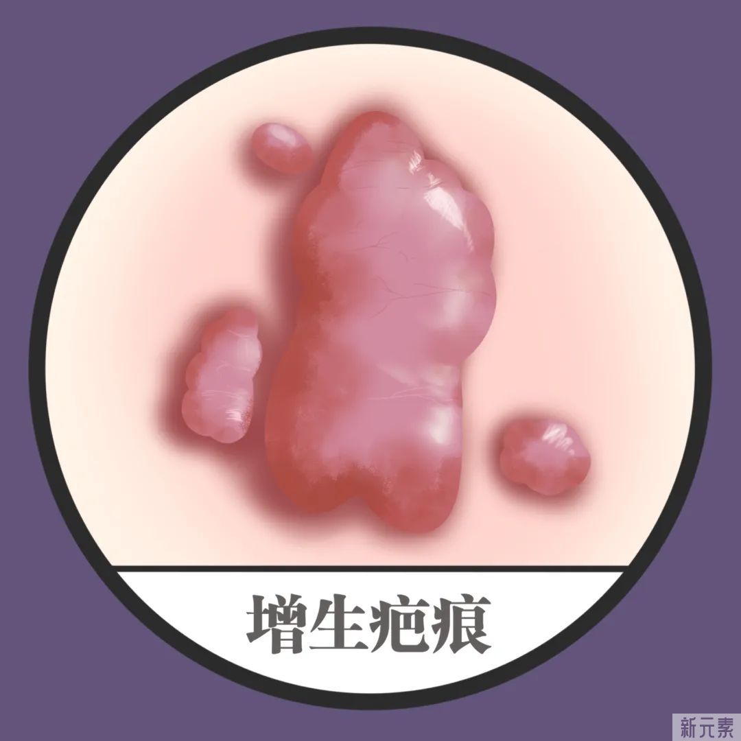 增生疤痕危害大，这些你都了解吗? 图片-2